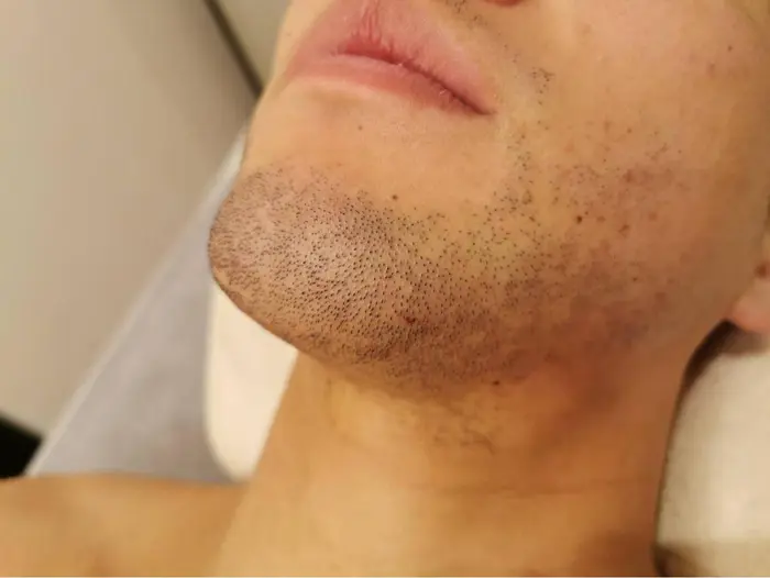 お髭脱毛二回目 ｒp ルピ所属 サロン Rpのエステ リラクカタログ ミニモ