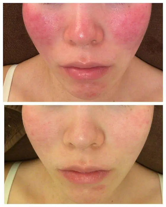 強い赤み 1回 肌トラブル改善専門店アクール池袋店所属 ニキビ改善専門サロン Accueil照山のエステ リラクカタログ ミニモ