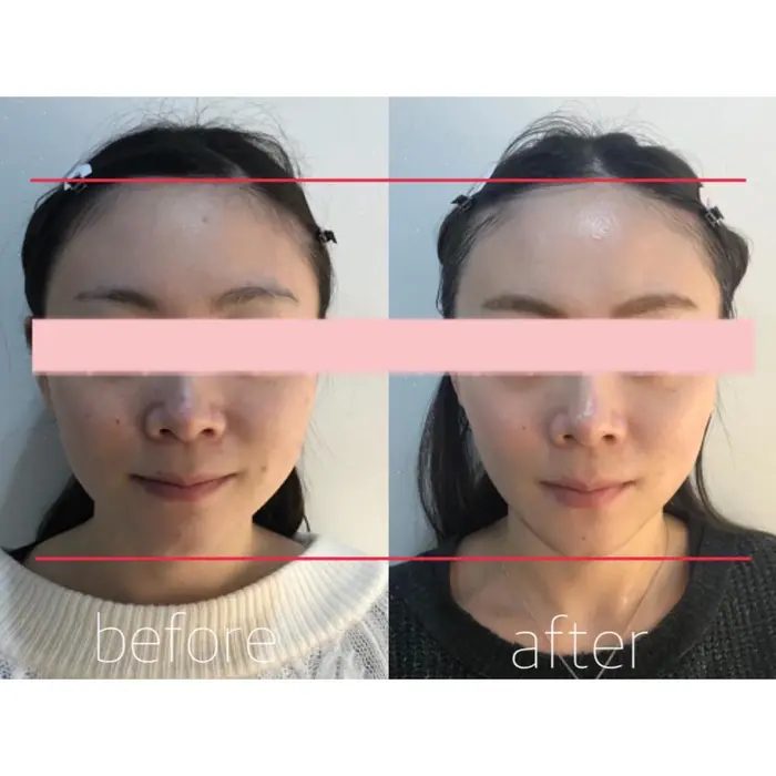 代女性 3回目8000shots 顔の脂肪 顔のたるみ 肌荒れの気になる方 Beauty Gym Behaing 柏店 ビハイング 所属 小顔美肌セルフエステ Behaingのエステ リラクカタログ ミニモ