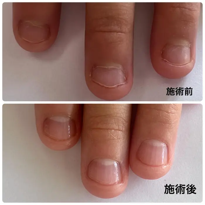 9歳学生 普通のネイルケア 施術時間約60分 つぼみネイル所属 大阪市ネイルサロン つぼみネイルのネイルデザイン ミニモ
