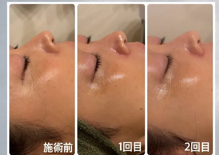 ラミネーションピールは、剥離を伴わないピーリングの一種
肌に必要な美...