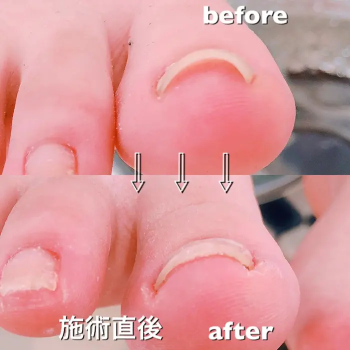 深爪 足の巻き爪 小さすぎる爪や伸びない爪でお悩みの方は是非ネイル出来ないお仕事の方もご相談 ネイルサロン カナン所属 Nailsalon Canaanのネイルデザイン ミニモ 深爪 足の巻き爪 小さすぎる爪や伸びない爪でお悩みの方は是非ネイル出来ないお仕事の方もご相談 ネイルサロン カナン所属 Nailsalon Canaanのネイルデザイン ミニモ