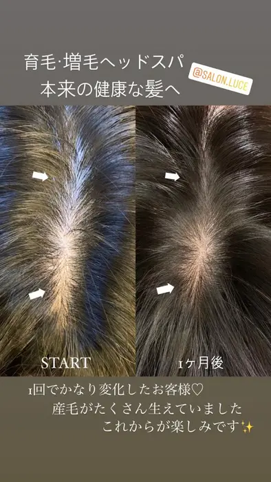 育毛 増毛 強髪ヘッドスパ 本気で薄毛改善したい方のための ヒト幹細胞培養液を使用したヘ Salon Luce サロンルーチェ所属 Salon Luceのヘアカタログ ミニモ