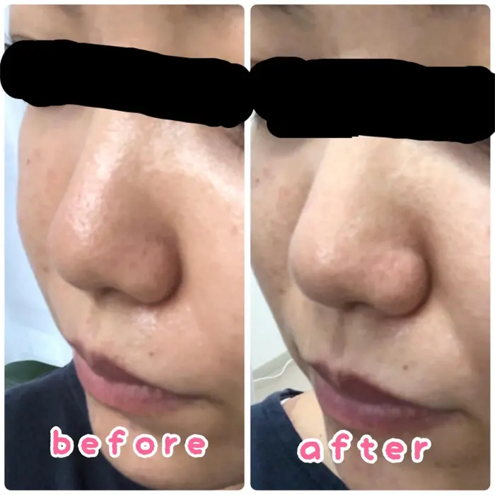 小鼻集中ケア 鼻がツルツルに 毛穴も目立ちにくくなっているのが分かります お好きなエステに Beauty Salon Ayu所属 柏葉 千晶のエステ リラクカタログ ミニモ