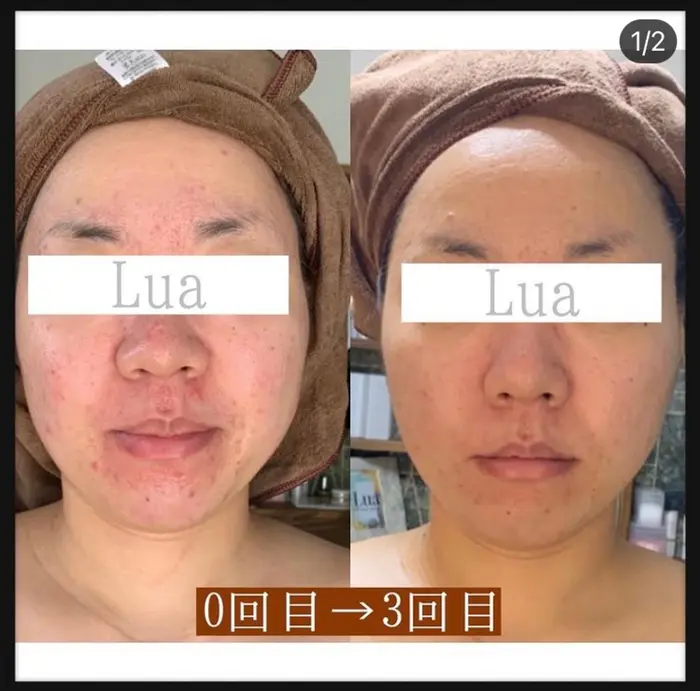 〆施術内容 ニキビ 吹き出物集中ケア フェイシャル 5000 デコルテ込み Lua ルア 所属 Lua ルアのエステ リラクカタログ ミニモ