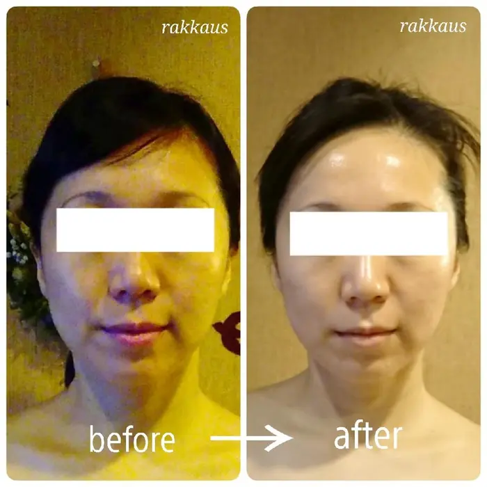 頬のたるみがなくなりスッキリしたフェイスラインに一回り小顔にくすみもとれ白肌に 陶板浴エステサロン ラッカウス所属 フェイシャル専門 ラッカウスのエステ リラクカタログ 20180714213310 ミニモ