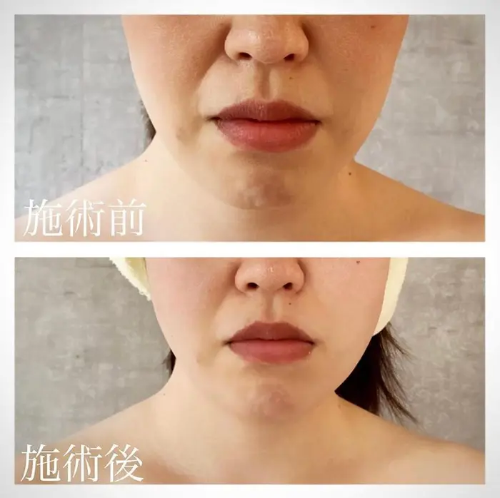 たるみとほうれい線を気にされて コルギ ハイフを受けられたお客様です 全体的にお顔がとても引き上が Re Bella Facial Herb所属 Re Bella 三浦のエステ リラクカタログ 20210504032306 ミニモ
