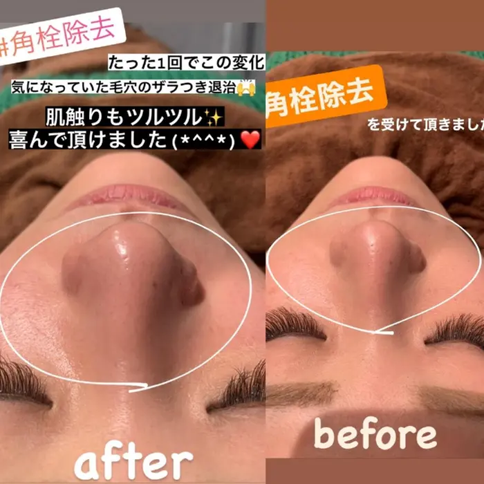 お鼻の黒ずみ 角栓除去 ミナ Vos 毛穴 ニキビ フェイシャル所属 ミナ 毛穴 ニキビ Vos ヘッドスパのヘアカタログ ミニモ