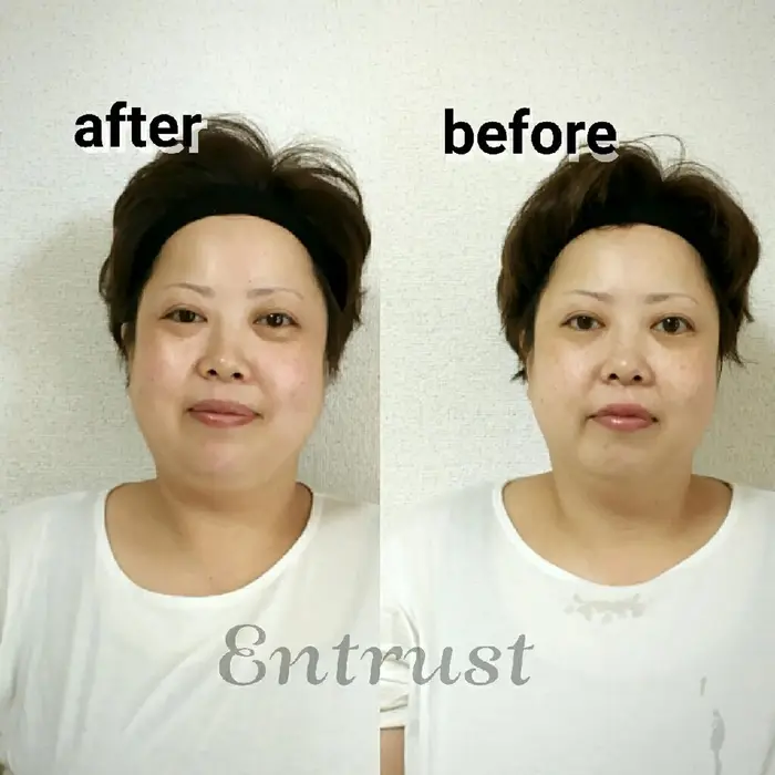 炭酸パック 金箔パックのwコース 赤み現象 特に目元と顎ラインがスッキリ 全体的に小顔に 肌はもっ Entrust所属 Entrust Staffのネイルデザイン ミニモ