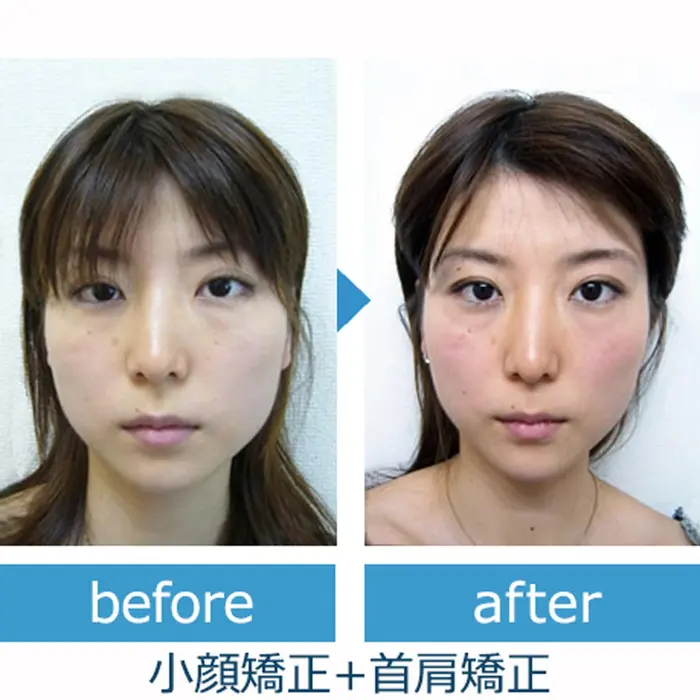 小顔矯正 首肩矯正 Before After 左右シンメトリー 頬骨 エラ張りにもアプ 美 Design 千葉店所属 美 Design 千葉店のエステ リラクカタログ ミニモ