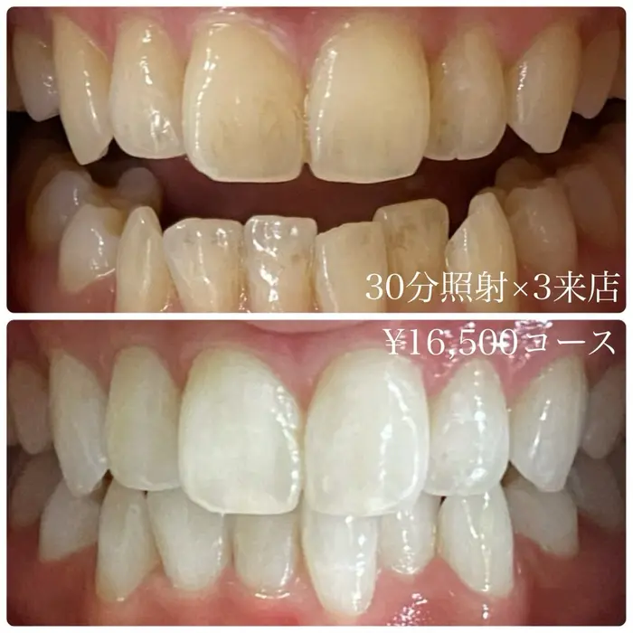  #ホワイトニング横浜 #セルフホワイトニング横浜   #横浜ホワイトニ?...