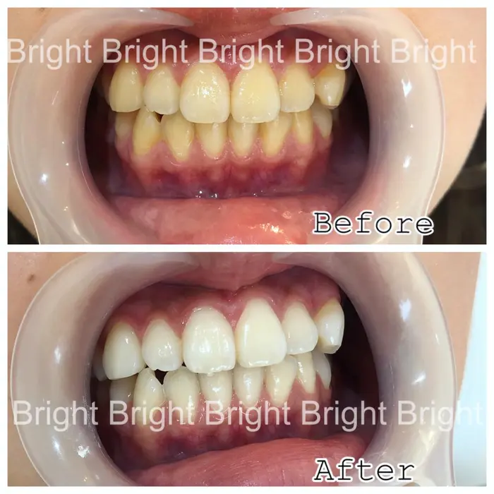 代女性 コンプレックスだったという黄味の強い歯がホワイトニングでとても白く綺麗になりました Bright所属 ホワイトニングサロン Brightのヘアカタログ ミニモ