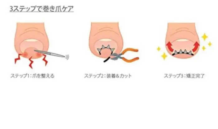 陥入爪は医師のいる病院へ 陥入爪は疾病です 巻き爪について Q2 巻き爪と陥入爪との違 フットケアサロンすりーぴんぐ所属 しお のネイル デザイン ミニモ