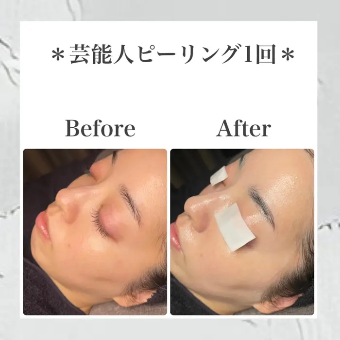 韓国肌管理室 ピーリング専門店 芸能人ピーリング 赤み 炎症 敏感肌 アトピー 1521 韓国肌管理室 所属 韓国ピー リング専門店のエステ リラクカタログ ミニモ