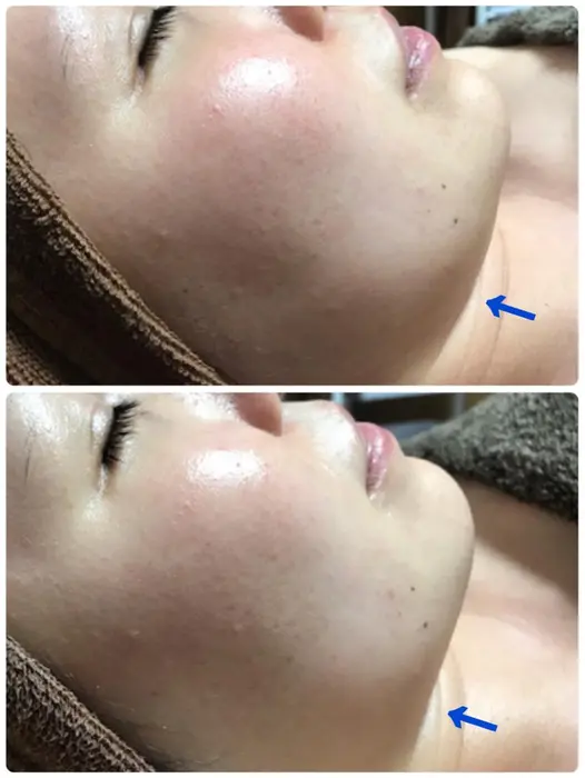 引き締め効果により小顔になります 美肌ケアもでき 小顔効果も得られる一石二鳥のハーブピーリング ハーブ専門dioneさいたま店所属 佐藤 えみのエステ リラクカタログ ミニモ