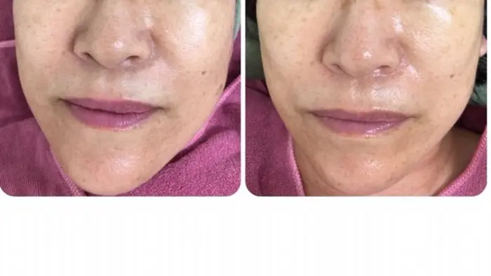 施術後の方がお顔全体が引き締まって メリハリのある立体顔になっています あごの部分はまるで別人の 毛穴たるみ改善フェイシャルエステm S Room所属 フェイシャルエステ M S Roomのエステ リラクカタログ ミニモ