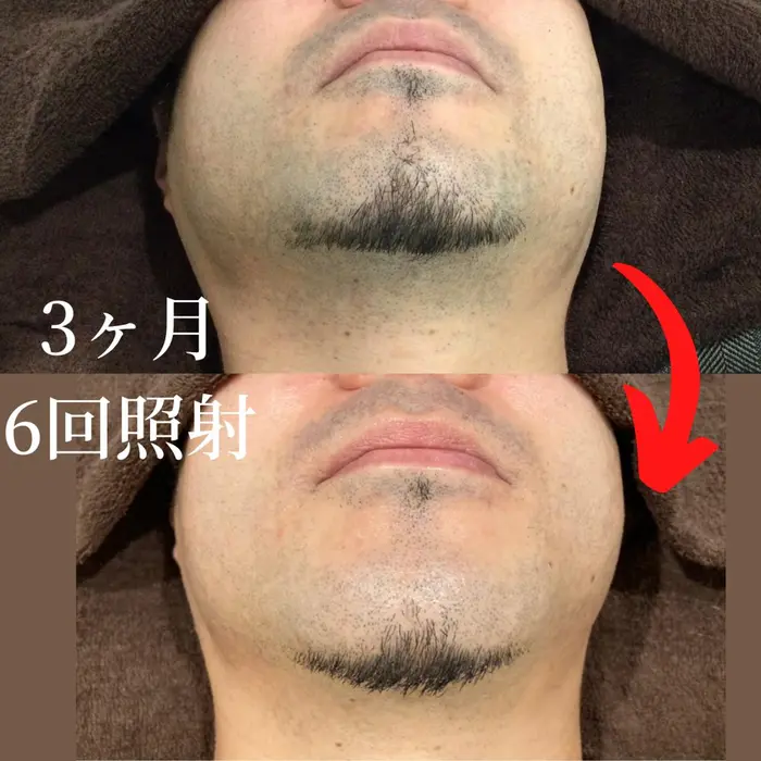 ヒゲ脱毛コース ビフォーアフター途中経過 芦屋のヒゲ脱毛 メンズ脱毛 Roi ロワ 所属 メンズ脱毛 Roi 金江尚子のエステ リラクカタログ ミニモ
