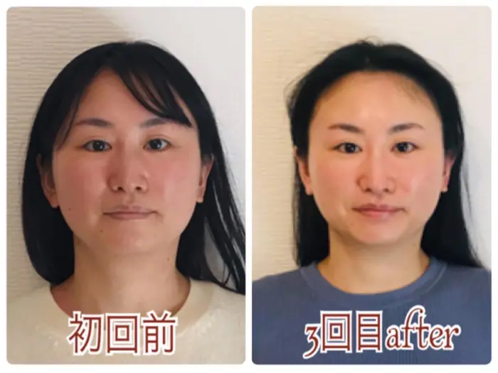 宇治市 30代 回数を重ねるごとに小顔に 京都の痛くない小顔矯正サロンmartha 宇治市の痛くない小顔矯正サロンmartha マーサ 所属 大軒 優子のエステ リラクカタログ ミニモ