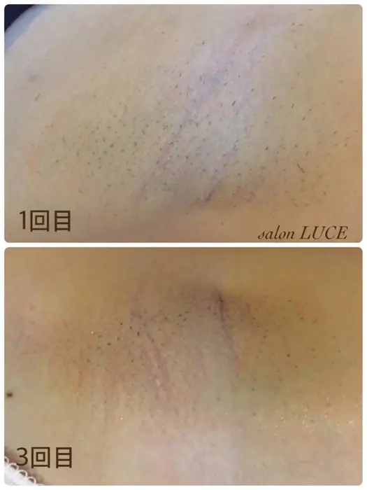 脇脱毛ビフォーアフターどんどんキレイになります Salon Luce サロンルーチェ所属 Salon Luceのヘアカタログ ミニモ