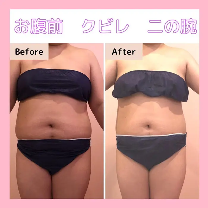 UNFAT】痩身クリーム