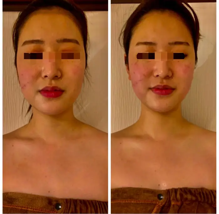 フェイスラインがクッキリ顎先が尖ると美人さんのお顔立ちになりますよ シェイプラボ所属 Shapelabo 店長 高橋のエステ リラクカタログ ミニモ