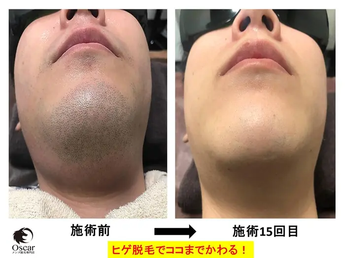 Oscar オスカー メンズ脱毛名古屋 髭 ヒゲ脱毛 男性脱毛 Vio脱毛 全身脱毛 永久脱毛 光脱 メンズ脱毛専門店oscar オスカー 所属 渡辺 裕之 脱毛技能士 のエステ リラクカタログ ミニモ