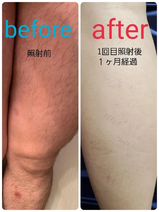 男性全身脱毛 毛には毛周期があるため 抜ける毛と抜けない毛がどうしてもでてしまいます です 脱毛サロンqlat所属 脱毛サロン Qlatのエステ リラクカタログ ミニモ 男性全身脱毛 毛には毛周期があるため 抜ける毛と抜けない毛がどうしてもでてしまいます です 脱毛サロンqlat所属 脱毛サロン Qlatのエステ リラクカタログ ミニモ