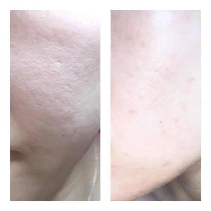 化粧ノリが変化してきたと感じたら しっかり毛穴が ツルツルに減ってきていて感動的です 美白成分で肌の フーレセラピーサロン Quale所属 生理痛 浮腫歪み 足圧 甲斐優花のエステ リラクカタログ ミニモ