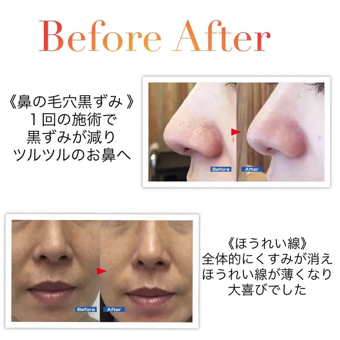 鼻の毛穴の黒ずみスッキリ くすみ改善 お肌のザラつき改善へ Es Esthetique Salon所属 眞野 彩夏のエステ リラクカタログ ミニモ