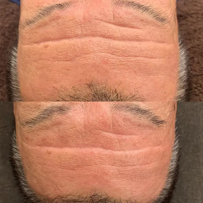 電気を流す美容鍼 リアン鍼灸接骨院所属 吉本 竜矢のエステ リラクカタログ ミニモ