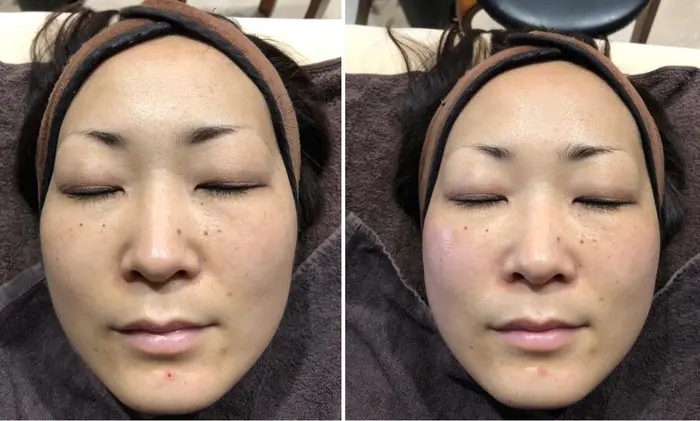 鍼ローラーでチクチク刺激がたまらない ツルツルツヤツヤで毎月快適 セントラル鍼灸院re Laxy所属 セントラル鍼灸院 Re Laxyのヘアカタログ ミニモ