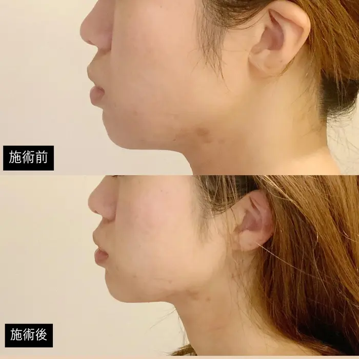 ハイフ00ショットの横顔です 美肌 小顔 痩身 専門店 マリーチクリニカルサロン Marici Clinical Salon所属 個室エステ Mariciマリーチのエステ リラクカタログ ミニモ