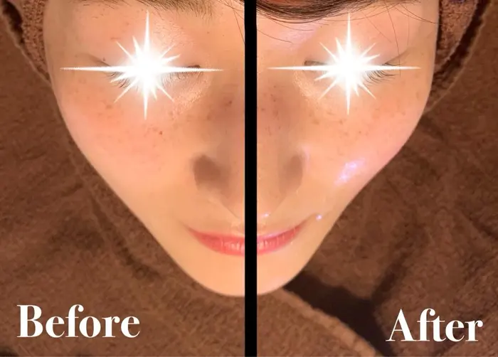 お顔のハイフのビフォー アフターです綺麗なvラインは勿論 ナチュラルな卵ラインを作るのも得意なので Nurse Salon所属 柴田 ゆりあのエステ リラクカタログ ミニモ