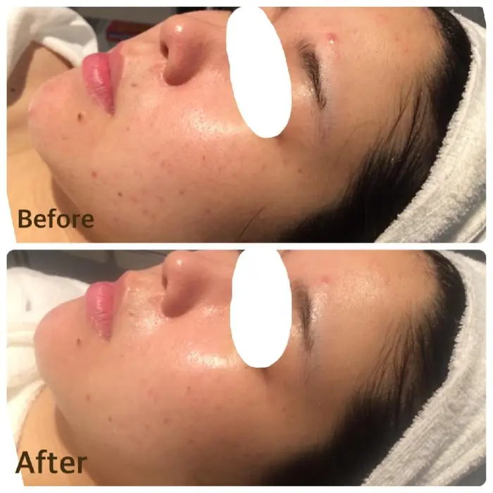 毛穴の美容液パックを使用しました ほほの毛穴の引き締め 眉上のニキビの炎症が引いた アゴ先の Dei M 京橋所属 Toyama Emiのエステ リラクカタログ ミニモ