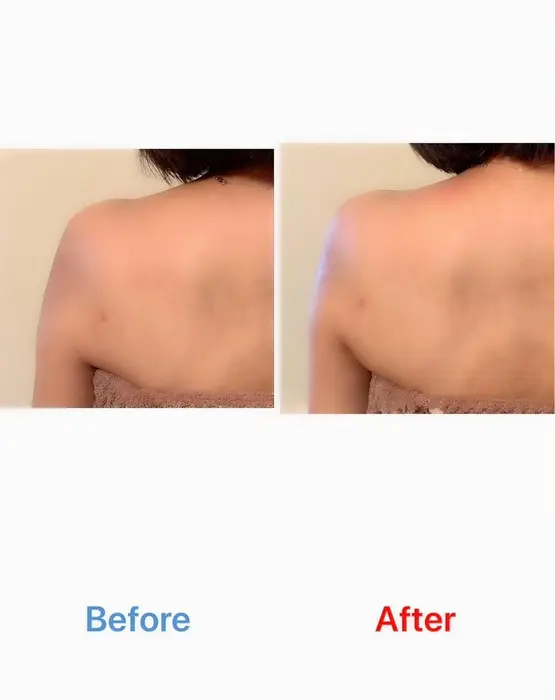 首肩ハイフのビフォーアフターお写真です一度で肩のもっこりと凝りを軽減させ しっかりと首長効果が期待 Nurse Salon所属 柴田 ゆりあのエステ リラクカタログ ミニモ