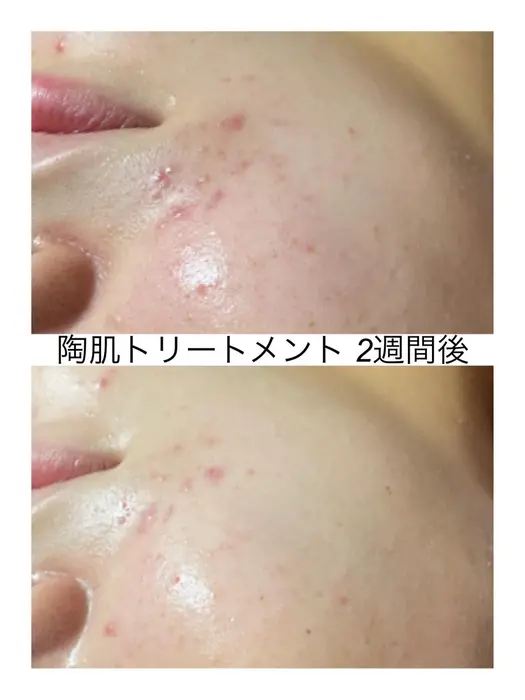 赤みの出るニキビ跡も引きますよ マスクの中で蒸れてニキビ菌が繁殖しやすいです マスク荒れにお悩み ハーブ専門dioneさいたま店所属 佐藤 えみのエステ リラクカタログ ミニモ