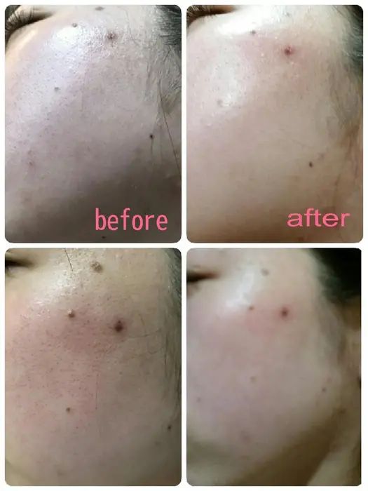 フォトフェイシャル 一回での効果 Tiara所属 磯田 美紀のエステ リラクカタログ ミニモ