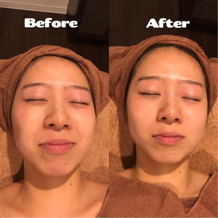 エラが気になる 頭を小さくしたい 首がもっと長かったら あなたのお悩みに合わせたパーソナルな組み合 Iris Serapia イリスセラピア 所属 後藤 美沙のエステ リラクカタログ ミニモ