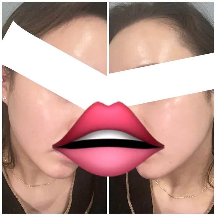 私の肌失礼します 顔脱毛と V3のファンデーションと フォトフェイシャルで肌を整えて ツヤをかなり 美容 整体サロン Berry S所属 坂元 果林のエステ リラクカタログ ミニモ