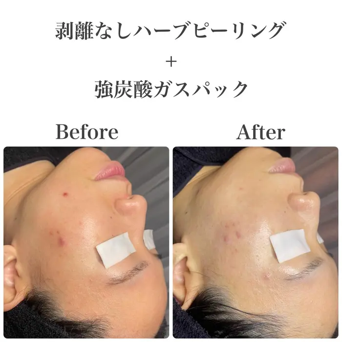 韓国肌管理室 韓国式剥離なしハーブピーリング 強炭酸ガスパック 1521 韓国肌管理室 所属 韓国ピー リング専門店のエステ リラクカタログ ミニモ