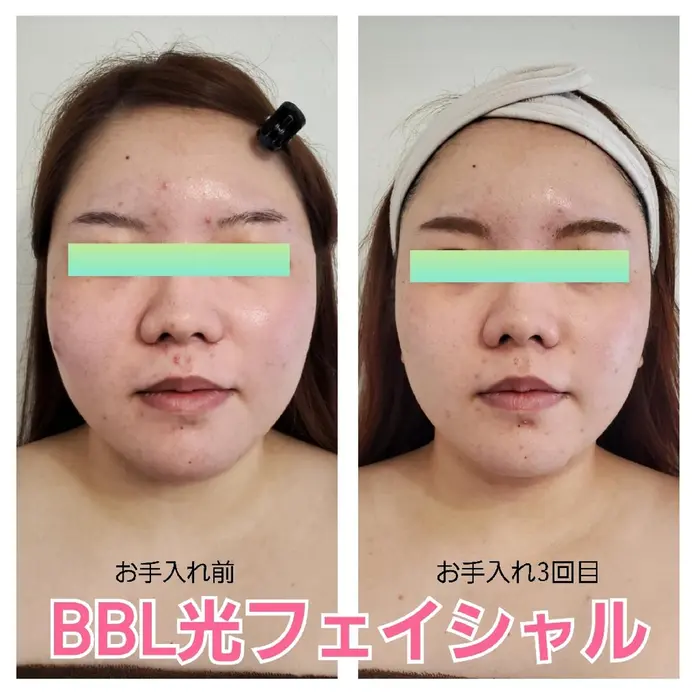 このお客様は 何人もの人に痩せたねと言われたそうです が 実際は4キロ太ってしまったそう lの Liam所属 プライベートサロン Liamのエステ リラクカタログ ミニモ