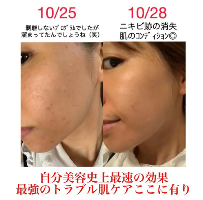 あらゆるお肌のお悩みを解決 乳酸ピーリングは医療レベルでありとってもお肌に優しい成分のものを採用し A Room Salon所属 A Room Salonのエステ リラクカタログ ミニモ あらゆるお肌のお悩みを解決 乳酸ピーリングは医療レベルでありとってもお肌に優しい成分のものを採用し A Room Salon所属 A Room Salonのエステ リラクカタログ ミニモ