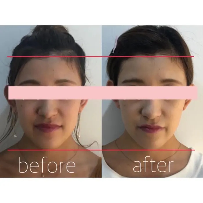 代女性 2回目8000shots 顔のたるみ 顔の脂肪が気になる方 Beauty Gym Behaing 柏店 ビハイング 所属 即日小顔セルフ エステ Behaingのエステ リラクカタログ ミニモ 代女性 2回目8000shots 顔のたるみ 顔の脂肪が気になる方 Beauty Gym Behaing 柏店 ビハイング 所属 即日小顔セルフ エステ Behaingのエステ リラクカタログ ミニモ