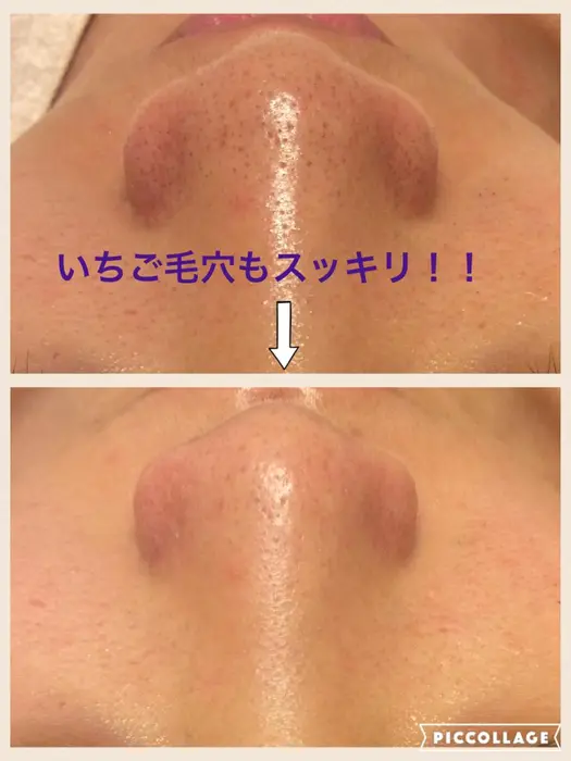 毛穴スッキリ洗顔 パック後 毛穴の脂汚れをしっかり落とし 角質を柔らかくして毛穴の中の汚れを引き上げ Salonラ クレール所属 腸美容専門サロン 北條夏美のエステ リラクカタログ ミニモ