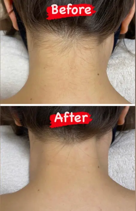 うなじ脱毛のbefore After Esrire イスリール 所属 Esrire Risaのエステ リラクカタログ ミニモ