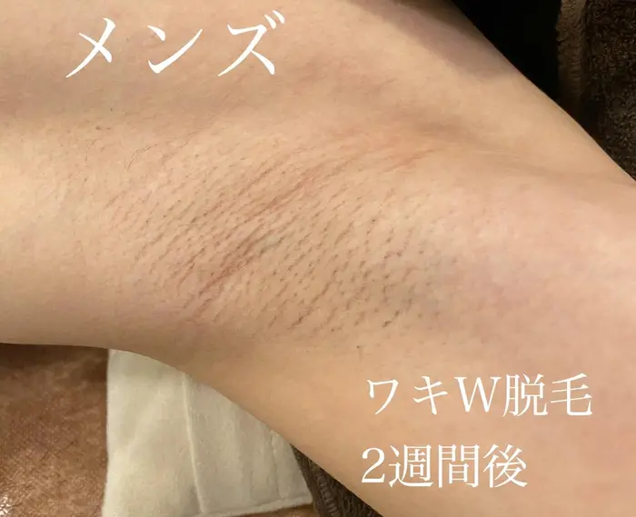メンズ ワキw脱毛2週間後 ワックスと光脱毛の同時施術でストレスのない脱毛期間を過ごせます気に Privatesalon Laseule所属 Laseule Yuiのエステ リラクカタログ ミニモ