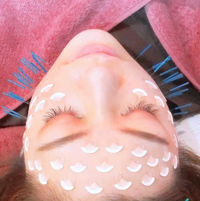 りんご鍼灸治療院所属 美容鍼灸アロマ Kawaiseraの口コミ ミニモ